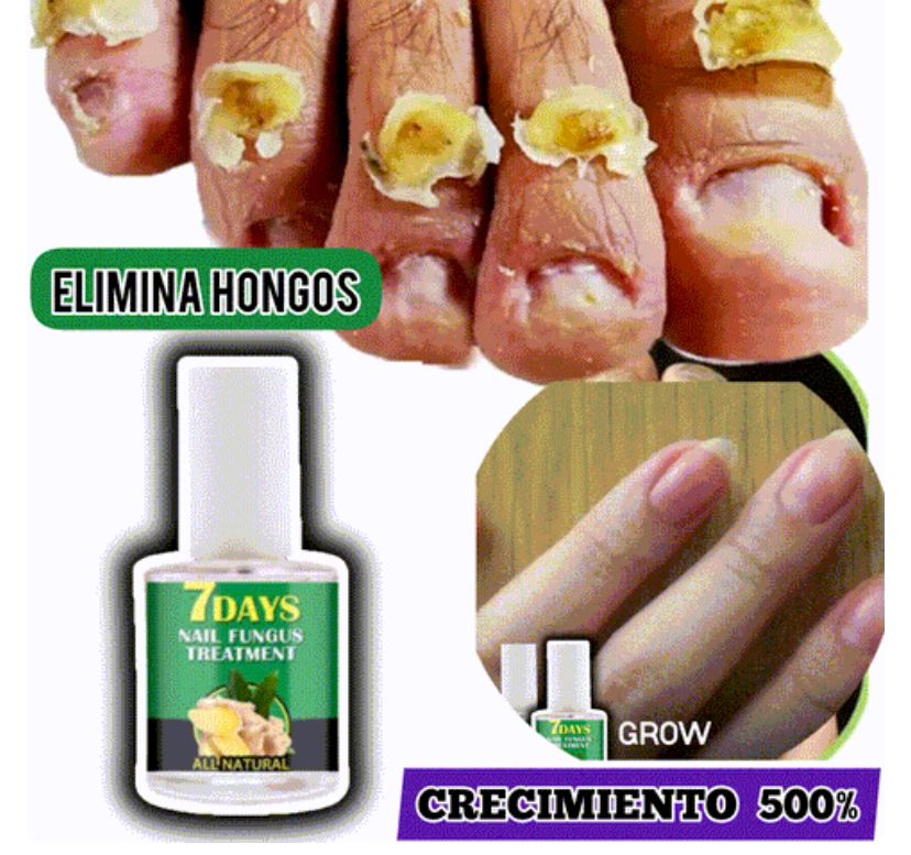 "FORTINAILS 7 DAYS Crecimiento y eliminacion de Hongos"